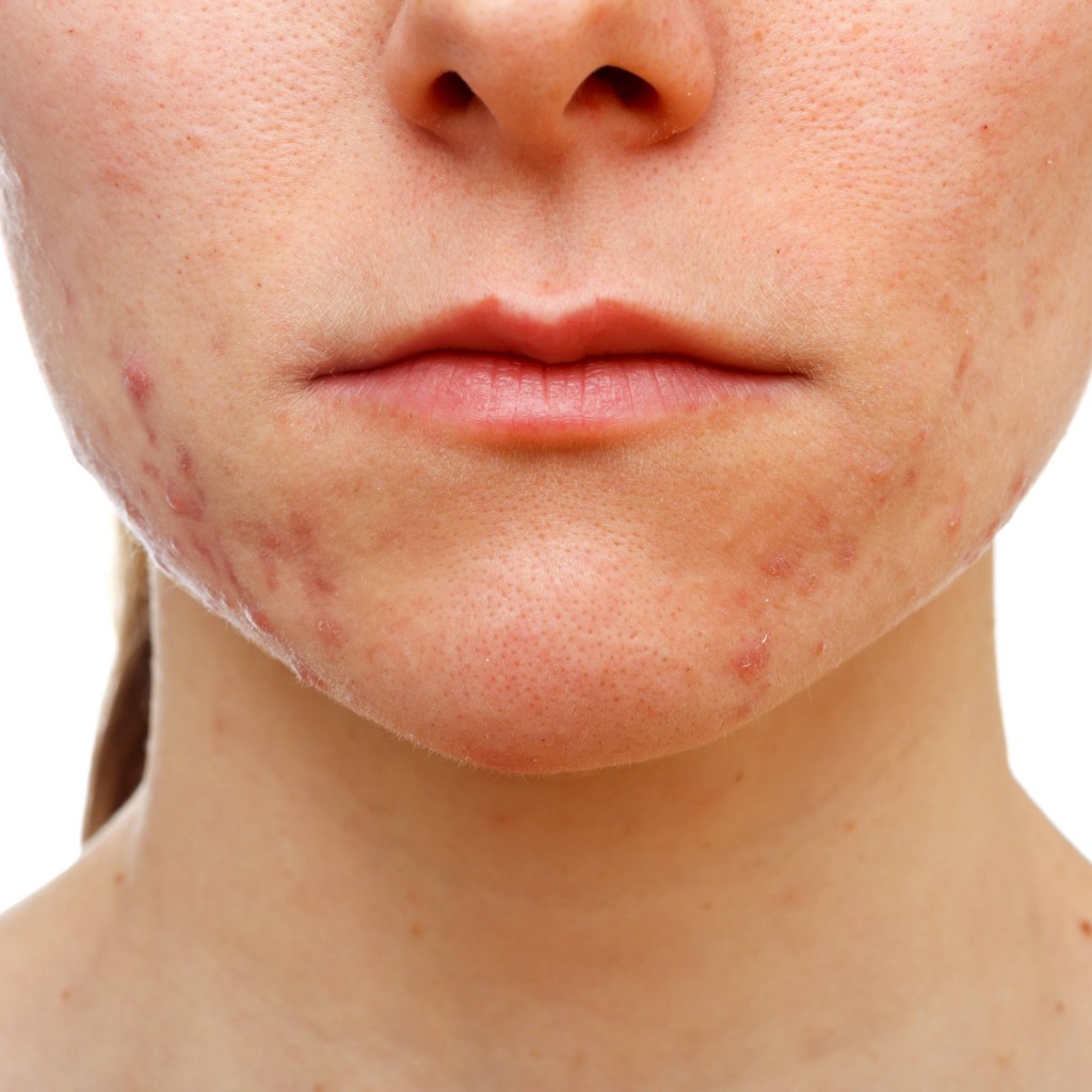 Se livre da acne com água ácida nível 1 da Tyent Brasil