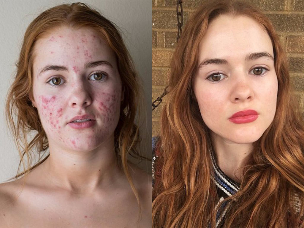 Excesso de acne causa autoestima. Água ácida é a solução!