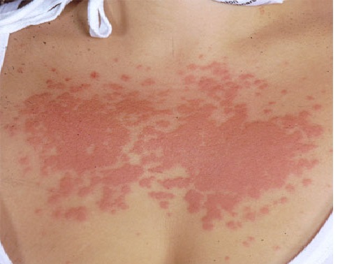 Fitofotomelanose: Uma doença de pele comum no verão